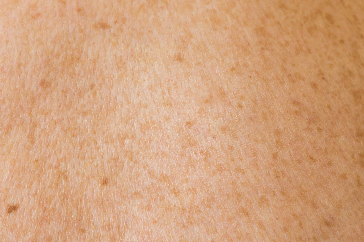 Cherry Angioma Removal aesthetic procedure at AMK Aesthetics