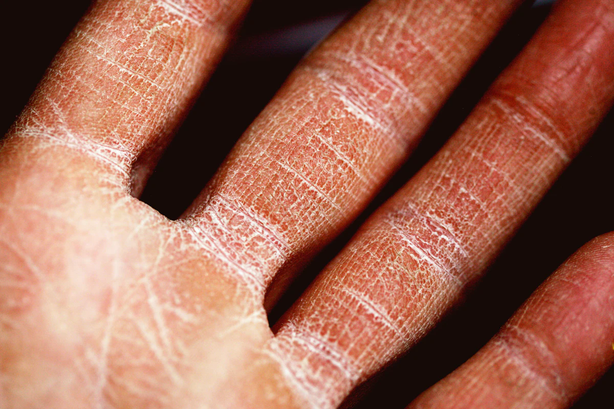 Eczema & Psoriasis Care aesthetic procedure at AMK Aesthetics