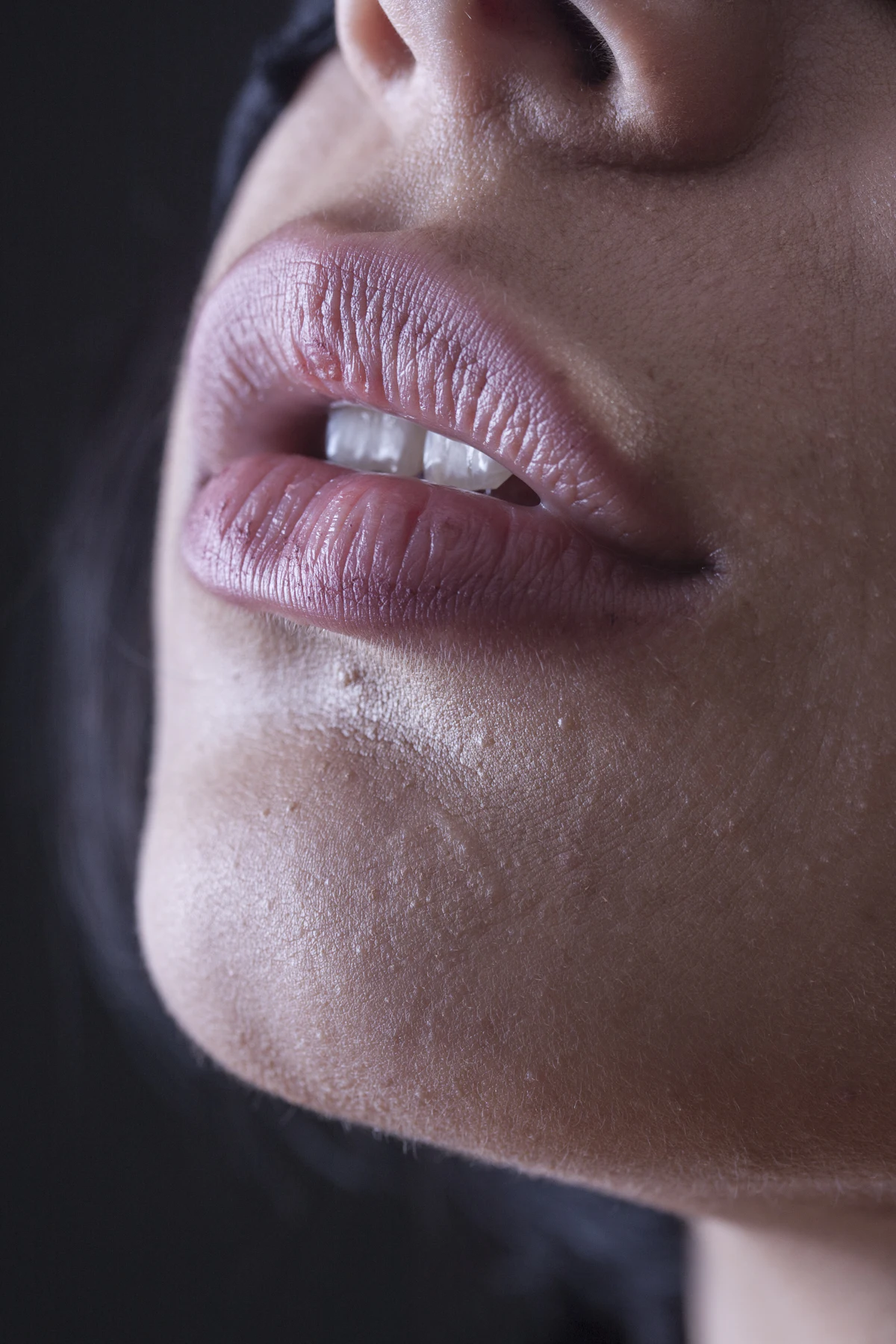 Gummy Smile Correction aesthetic procedure at AMK Aesthetics