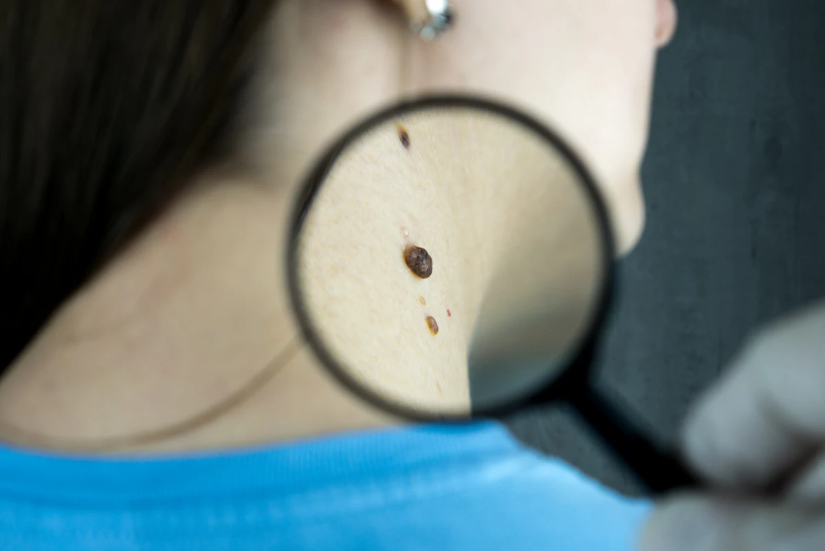 Mole Removal aesthetic procedure at AMK Aesthetics