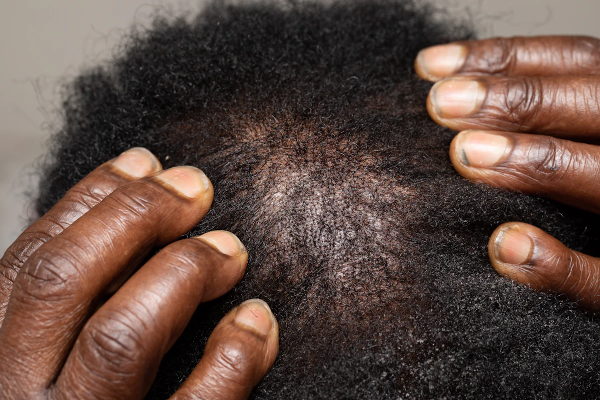 Scalp Detox aesthetic procedure at AMK Aesthetics