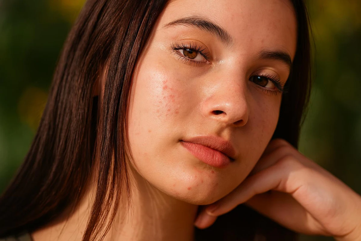 Sebaceous Hyperplasia Treatment aesthetic procedure at AMK Aesthetics