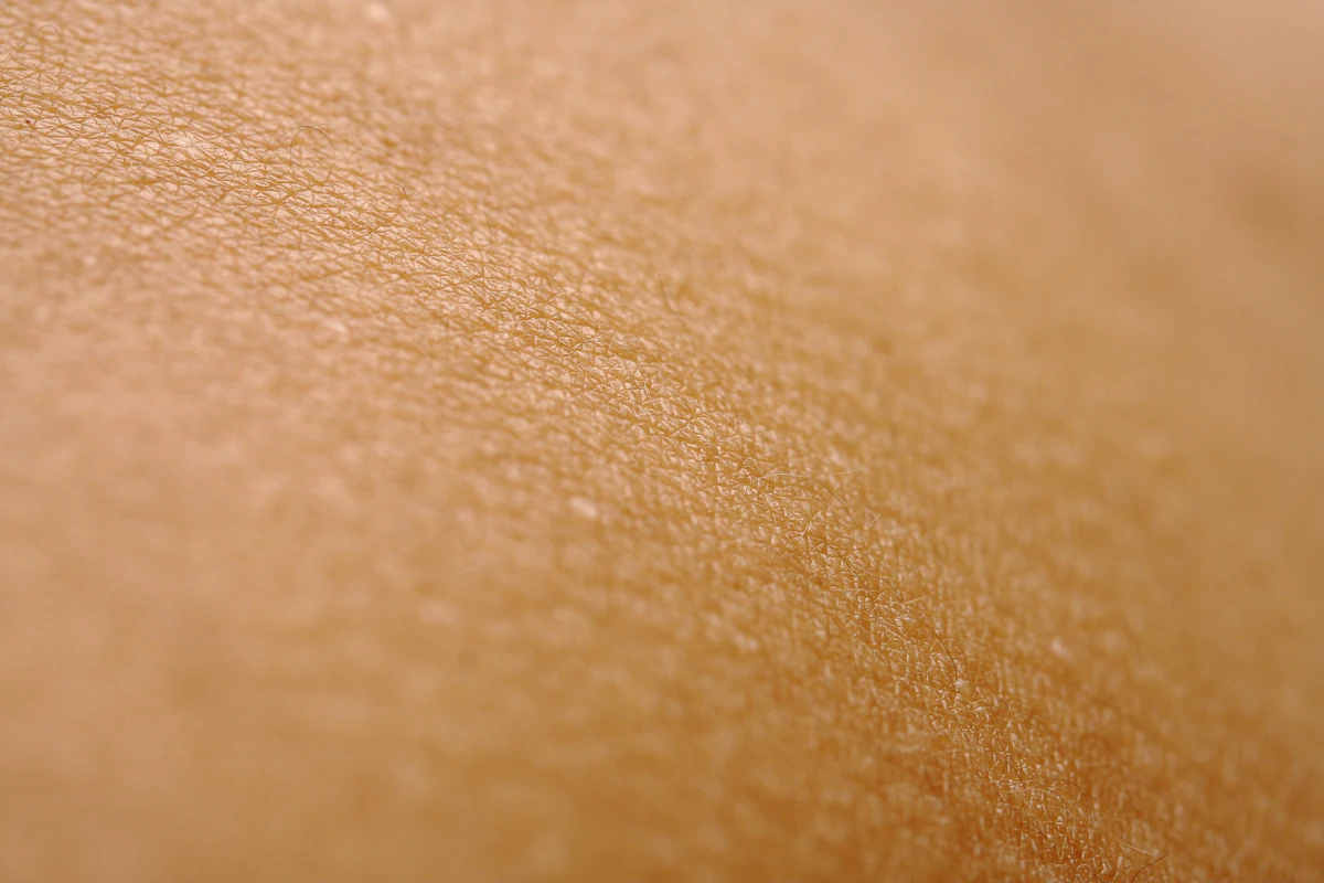 Stretch Mark Treatment aesthetic procedure at AMK Aesthetics